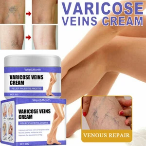 Crema de decoloración para el cuidado de las venas varicosas crema para piernas venas pomada herbal 30 g - Imagen 1 de 9