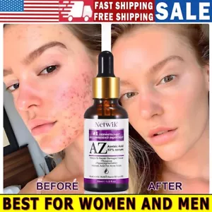 10% Azelaic Acid Serum 30ml | Acne, Blemishes, Dark Spots Corrector for Face - Picture 1 of 8