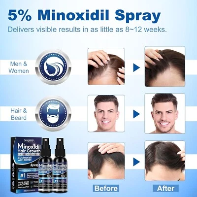 2 botellas 5% minoxidil spray para el crecimiento del cabello para hombres mujeres pérdida de cabello regeneración adelgazamiento Foto 1 de 4