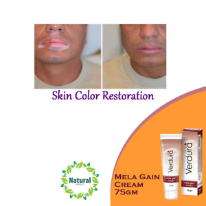 Vitiligo Treatment - Mela Gain Cream 75gm Helps Skin Colour Restoration Vitiligo
