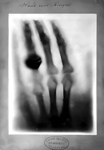 Radiograph of Hand by W.K. Roentgen X-ray Ring Photo Poster Art Print 18 x 24 in - Picture 1 of 2