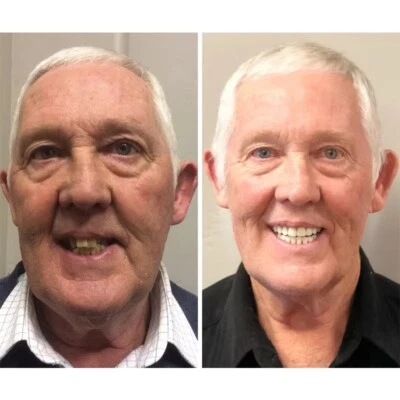 INSTANT SMILE Snap On False Teeth Upper & Lower Dental Veneers Dentures Tooth Cover Set Dental