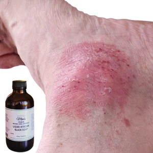 Fra Fra's Mini's | Premium EXTREME Healing Psoriasis Liquid Black Soap Blend 4oz - Picture 1 of 4