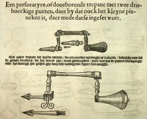 Gravure tirée de PARÉ Ambroise, OUTILS DE CHIRURGIE DE CAUTÉRISATION TRÉPANATION - Imagen 1 de 3