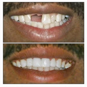 TEMPORARY TOOTH REPAIR or REPLACE KIT DIY makes 25-30 teeth *No Adhesive needed* - Picture 1 of 6