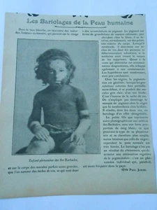 Enfant phénomène des Iles Barbades Les Bariolages de la peau 1905 Image Print - Imagen 1 de 1