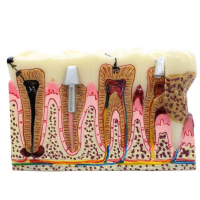 BOMAOER Zahnärztliche Anatomie von Zahnkaries Kunststoffzähne Modell Vorführkommunikatio