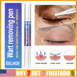 Wart Remover Pen Skin Tag Mole Remover Eliminate Foot Corn Warts Unisex BEST - Picture 1 of 10
