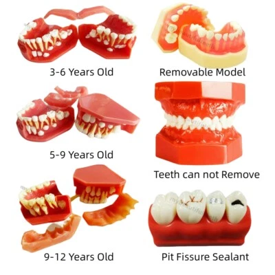 Dental Teeth Model Children Permanent Alternate Pit Fissure Sealant Seal 6Type - Image 1 of 4