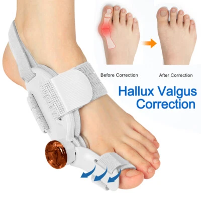 Hallux Valgus Corrección Juanete Férula Alisador Dedo Grande Alivio Del Dolor De Pie Pro Foto 1 de 4