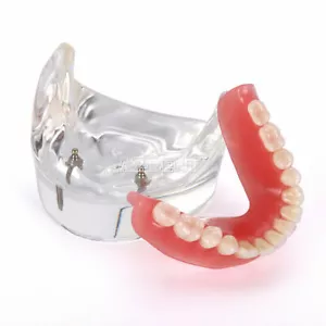 Dental Implant Teeth Model Mandibular Overdenture Restoration 2 Lower Implants - Picture 1 of 9