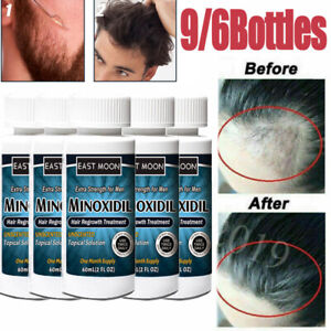 9/6 Month Anti Hair Loss Hair Regrowth Extra Strength Topical Treatment Solution