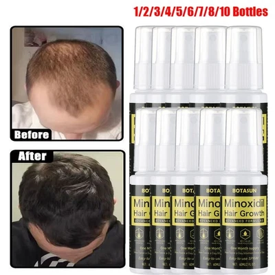 1-10x Minoxidil 5% Extra Fuerza para Hombres Tratamiento de Regeneración del Cabello Solución en Spray Foto 1 de 4
