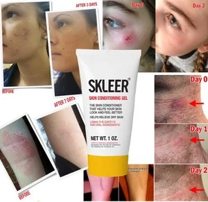 Acne, Pimples, Psoriasis, Natural Gel with Tea Tree Oil - SKLEER Gel - Picture 1 of 16