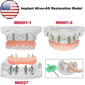 US Dental Overdenture Implant Teeth Model Upper/Lower Jaw Type With 4/6 Screws - Picture 1 of 56