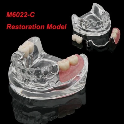 Dental Typodont Model M6022-C w/ Partial Denture 2 Demo& Implants Restoration - Image 1 of 4