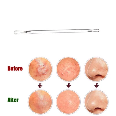 Comedones Remover Blackhead Acne Blemish Extractor Tool Facial Skincare - Imagen 1 de 4