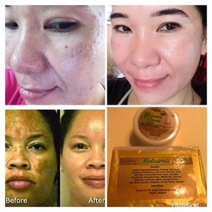 spot cream for melasma