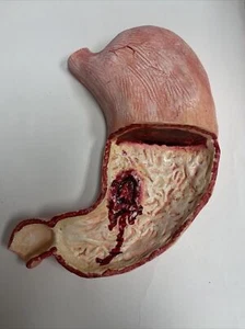 Vintage Stomach Peptic Ulcer Anatomical Pathology Model 2 - Picture 1 of 3