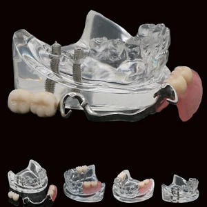Modelo de reparación de implantes dentales prótesis parciales removibles modelo Typodont transparente - Imagen 1 de 13