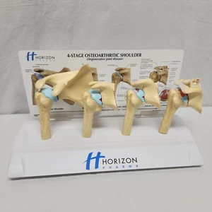 Degenerative Joint Disease 4 Stage Osteoarthritis Osteoarthritic Shoulder Model - Picture 1 of 13