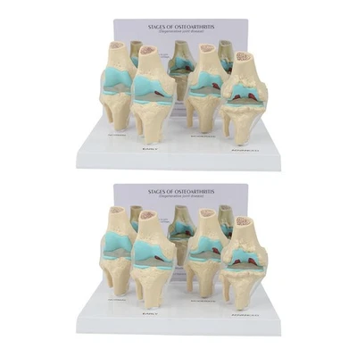 2X Juego de Rodillas, Modelo de Anatomía de Artrosis con Tarjeta de Llave Pedagógica, 4 Piezas1828 - Imagen 1 de 4