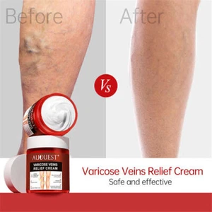 Crema de tratamiento para eliminación de venas varicosas anti arañas estrías vasculitis CALIENTE- - Imagen 1 de 9