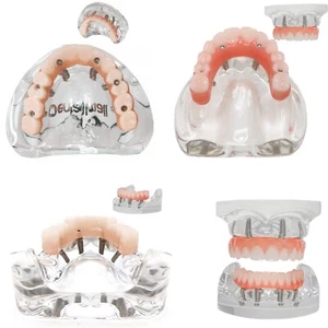 Dental Implant Modle Overdenture treatment Restoration Model U/L Jaw 4/6 Screws - Picture 1 of 65