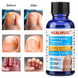 ANTI FUNGAL SUPPORT EXTRA STRENGTH TOENAIL FUNGUS ATHLETES FOOT FUNGI NAIL SERUM - Picture 1 of 18
