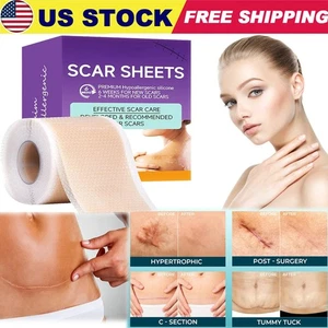 Silicone Scar Sheets,(1.6" X 120" Roll- 3M) Silicone Scar Tape for Surgical Scar - Picture 1 of 17