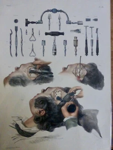 1850 ANATOMIE CHIRURGIE instruments chirurgicaux pour trépanation 1 LITHOGRAPHIE - Imagen 1 de 3