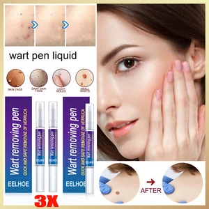 Penna rimozione verruche 12 ore etichetta pelle rimozione talpe elimina piede mais verruche unisex - Foto 1 di 13