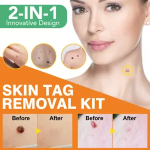 Warzenentferner Set Skin Tag Remover Schmerzloser Warze Entferner Mole Removal - Picture 1 of 15