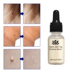 12 Hours 20ml Wart Remover Skin Tag Mole Remover Eliminate Foot Corn Wart liquid - Picture 1 of 12