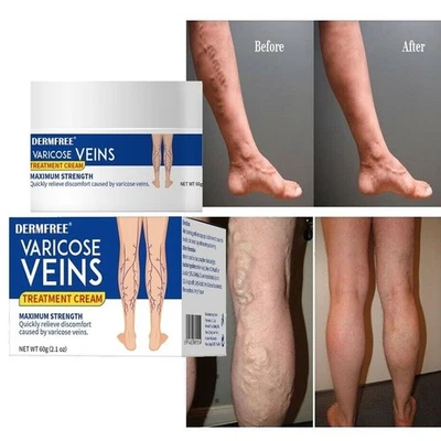 DERMFREE Varicose Veins Treatment Cream Ointment Relief Pain Vasculitis Phlebitis Gel 60g