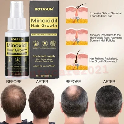 BOTASUN 60ml Extra Minoxidil 5% das Haarwachstum Serum Spray für Männer 1 Monats-Vorrat