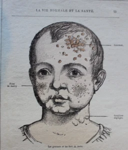 Antiker Holzstich Indispositions et maladies des enfants 19. Jahrhundert - Bild 1 von 3