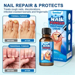 20ML Nail Fungus Treatment Liquid For Toenail Fungus Athletes Foot Fungi Nails - Picture 1 of 10