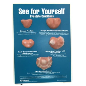 Health Edco Health Education Model - Prostate Conditions Easel Display - Picture 1 of 1