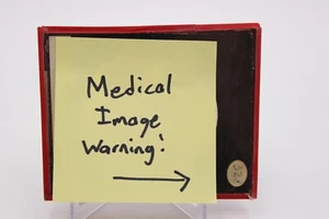 Linterna mágica Medical Oddity diapositiva de vidrio - CIRUGÍA DE HERIDAS ABIERTAS Historia quirúrgica - Imagen 1 de 6