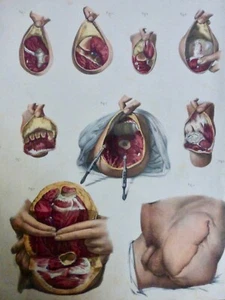 1850 ANATOMIE CHIRURGIE Diverses amputations bras jambe pied 1 LITHOGRAPHIE - Imagen 1 de 3
