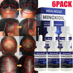 6~Minoxidil 5% Extra Strength For Men Women 6Month Supply Hair Regrowth Solution - Bild 1 von 20