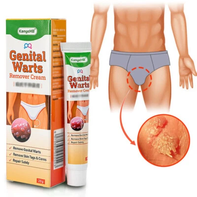 NICHT MARKENGESCHÜTZT Warzenentferner Haut Tags & Hühneraugen Creme Antibakterielle Behandlung