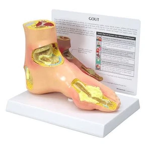 Modelo anatómico pie de gota con tarjeta clave LFA #1985. ¡Haznos una oferta! VER VIDEO - Imagen 1 de 7