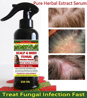 TREAT & HEAL POTENT REMEDY FOR SCALP & SKIN FUNGAL INFECTIONS - PURE HERBAL EXTRACT 250 ML