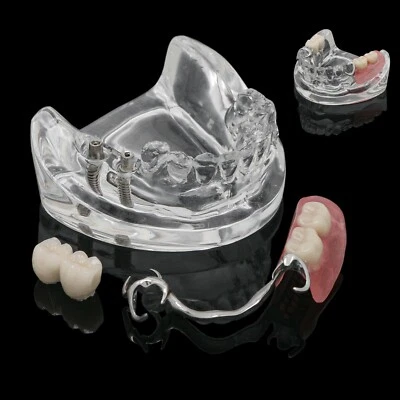 Модель для восстановления зубных протезов Typodont Partial прозрачная с 2 имплантатами демонстрационная 6022 - Изображение 1 из 4