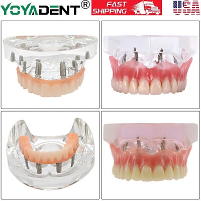 Модель зубных протезов нижних 4/6 имплантатов демонстрационная верхняя/нижняя съемная - Изображение 1 из 4