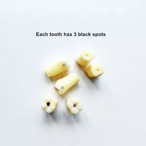 5pcs Dental Molar Vitro Dientes Caries Diente Modelo Dentista Escuela de Estudiantes - Imagen 1 de 9