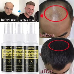 Minoxidil 5% Extra Strength Men 3 Month Supply Hair Regrowth Treatment Solution - Picture 1 of 17