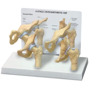 Modelo de cadera para ostoartritis de 4 etapas - Imagen 1 de 1